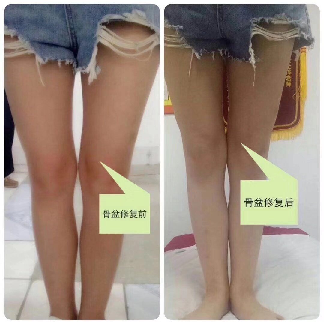 骨盆修复.jpg